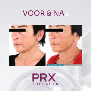 PRX voor en na